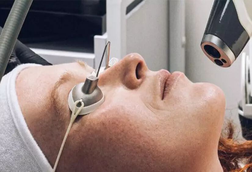 Non-Ablative Laser