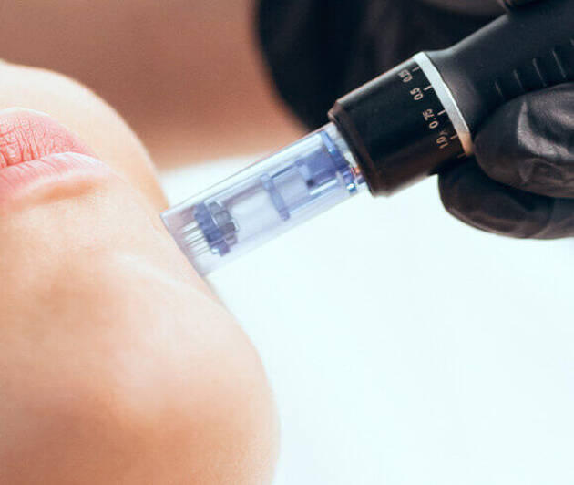 Microneedling Glace Image