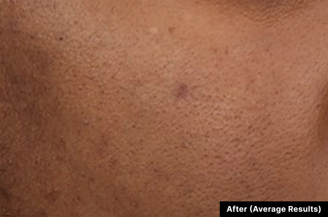 Before and After Discoloration Defense Dark Spot Corrector Serum